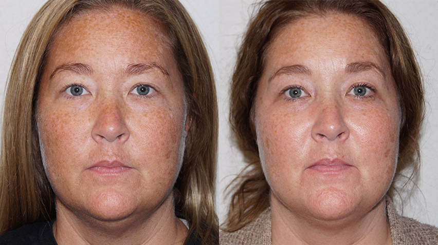 Chemical peel results